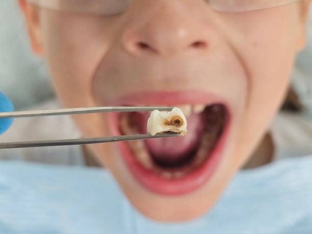 Best Emergency Tooth Extraction in Richlands, NC